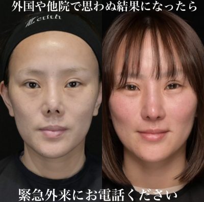 拘縮鼻