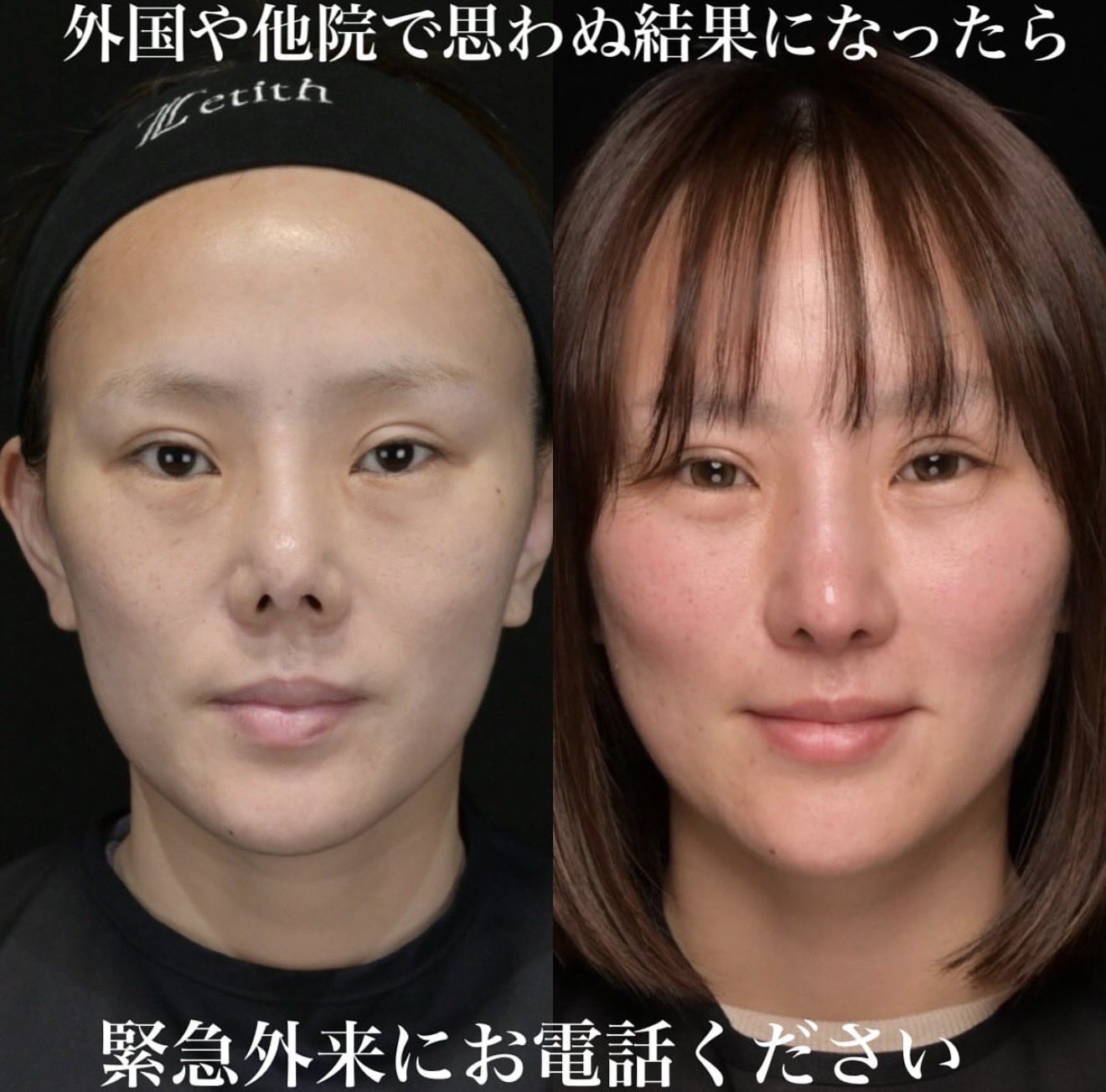 拘縮鼻