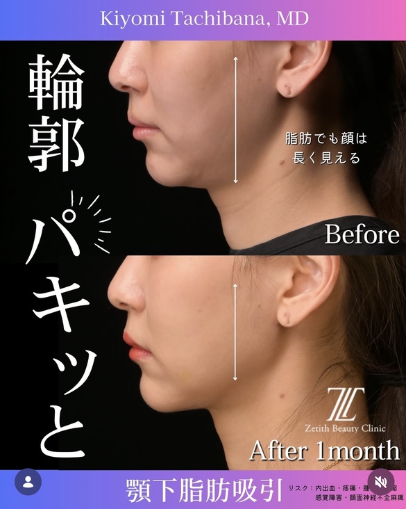脂肪吸引の術前と術後の写真