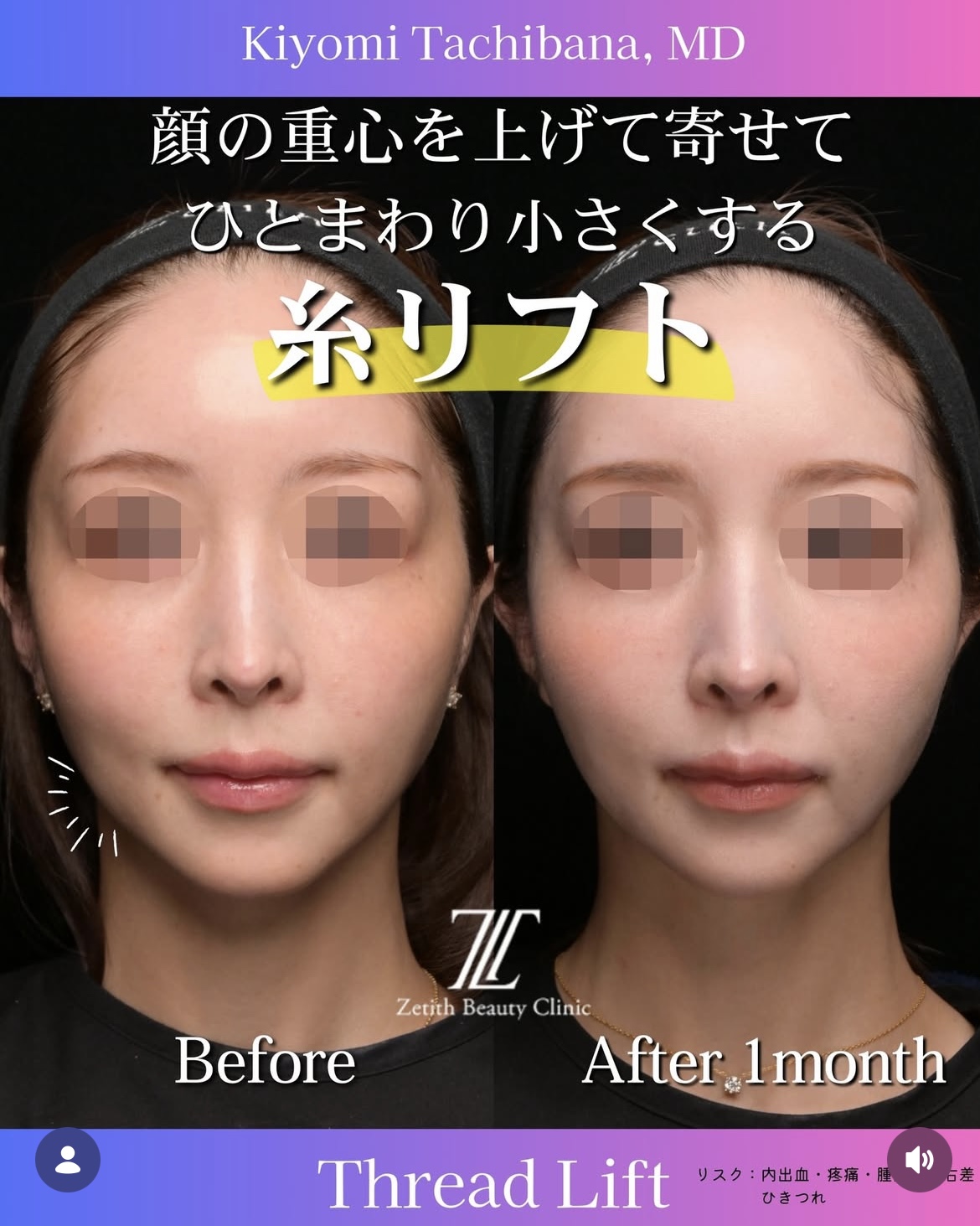 糸リフトのビフォーアフターの写真