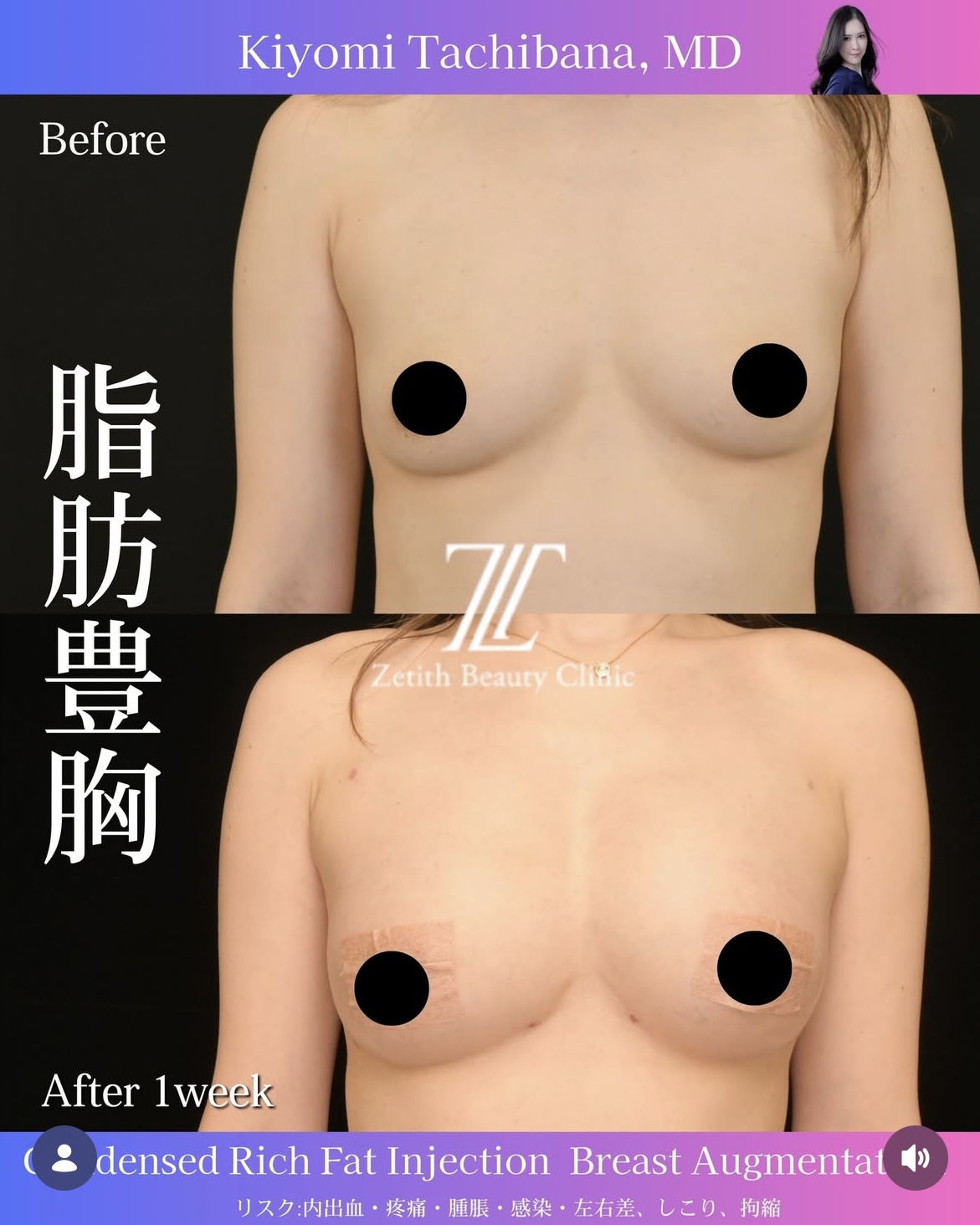 脂肪豊胸のビフォーアフターの写真