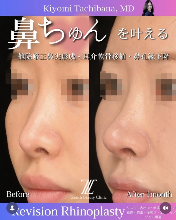 鼻整形のビフォーアフターの写真