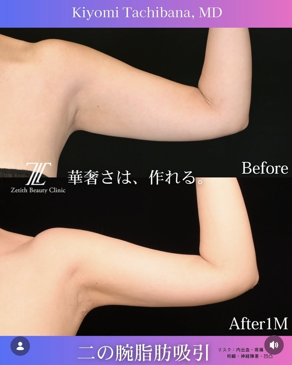 脂肪吸引のビフォーアフターの写真