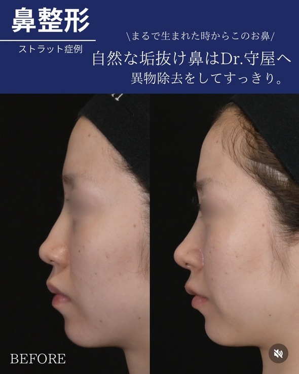 鼻整形のビフォーアフター写真(術前)