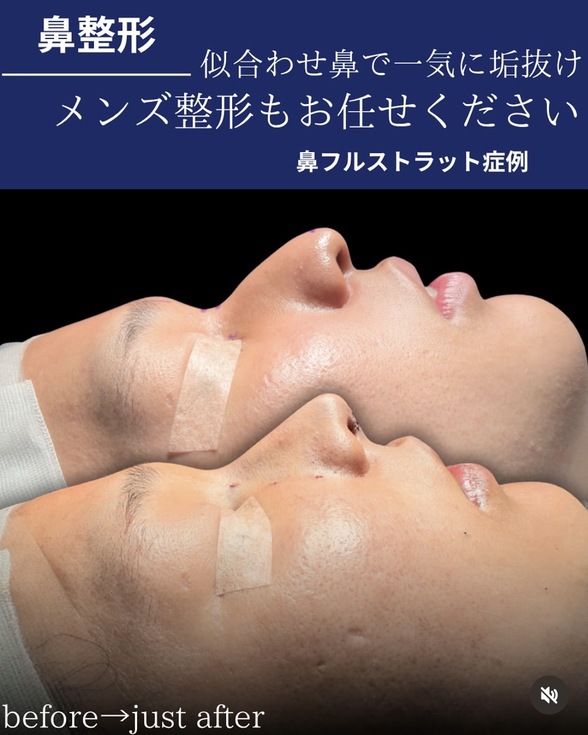鼻整形のビフォーアフター写真(術前)