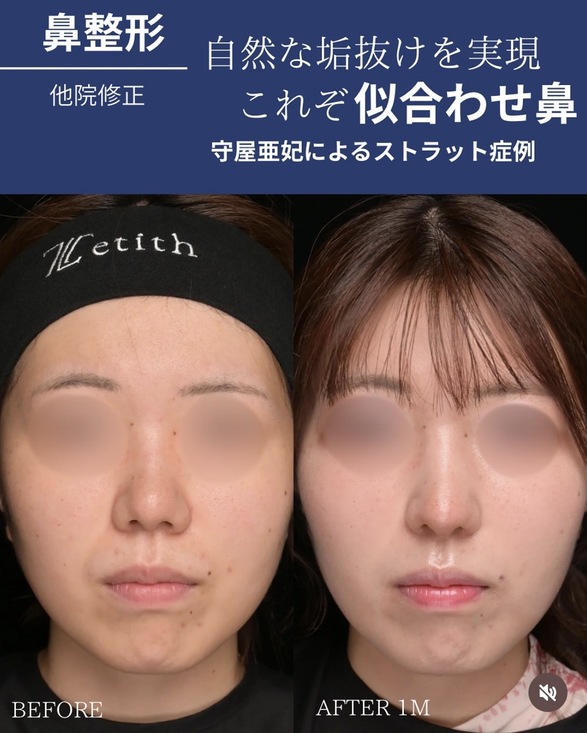 鼻整形のビフォーアフター写真(術前)