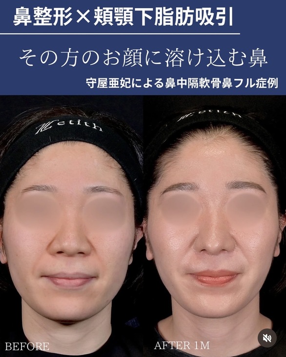 鼻整形のビフォーアフター写真(術前)