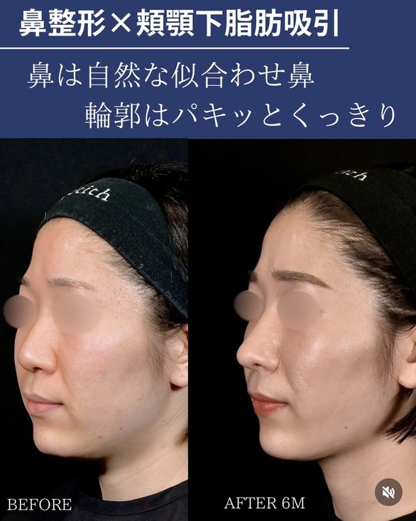 鼻整形のビフォーアフター写真(術前)