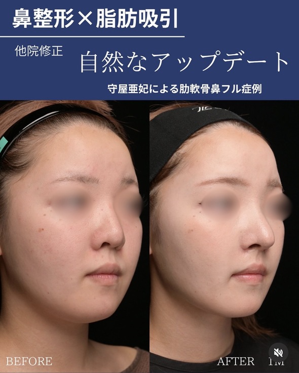 鼻整形のビフォーアフター写真(術前)