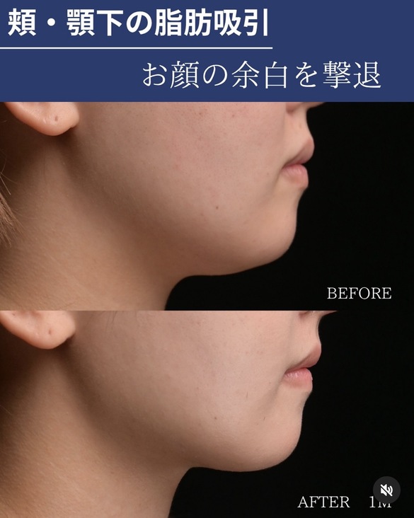 脂肪吸引のビフォーアフター写真(術前)