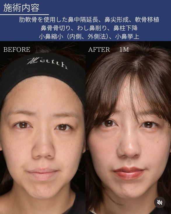 鼻整形のビフォーアフター写真