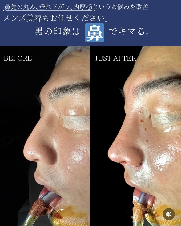 鼻整形のビフォーアフター写真