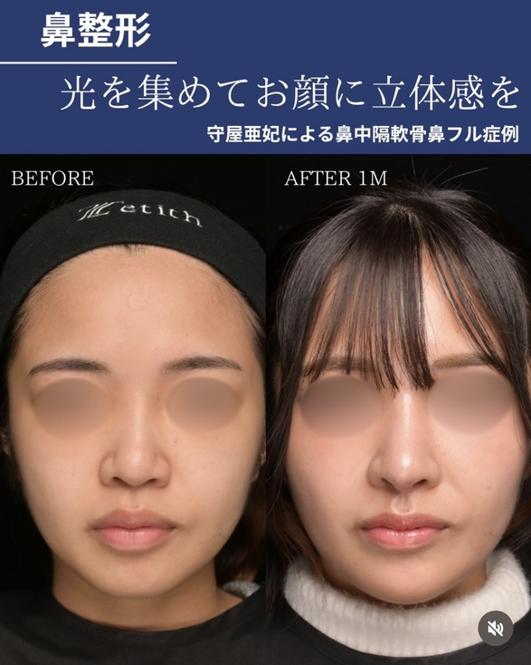 鼻整形のビフォーアフター写真(術前)
