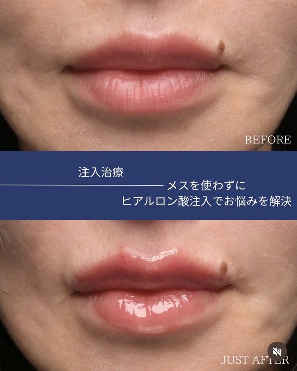 ヒアルロン酸注入のビフォーアフターの写真