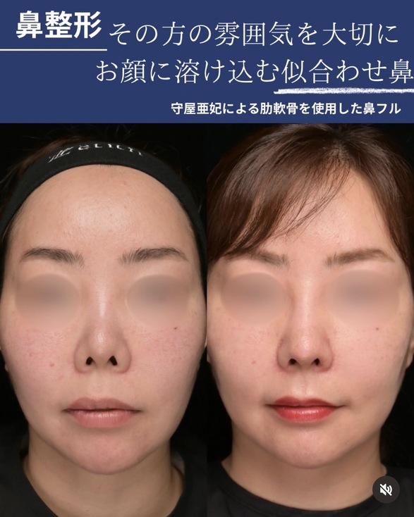 鼻整形のビフォーアフターの写真