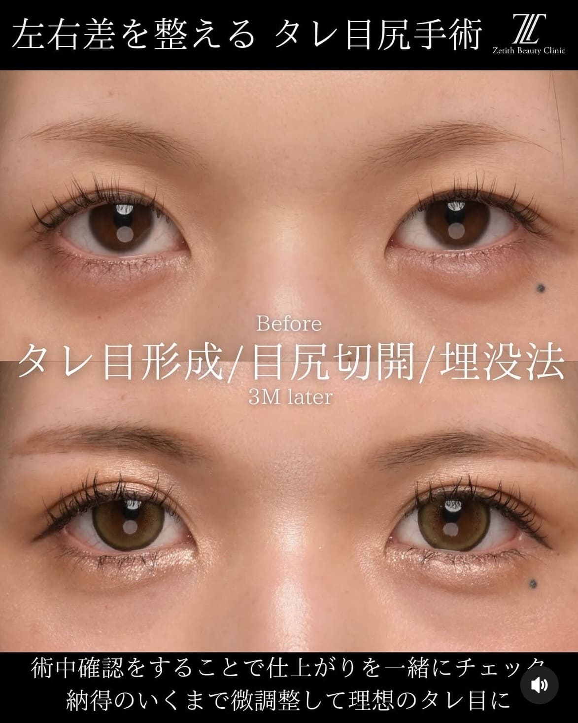 目元整形のビフォーアフターの写真