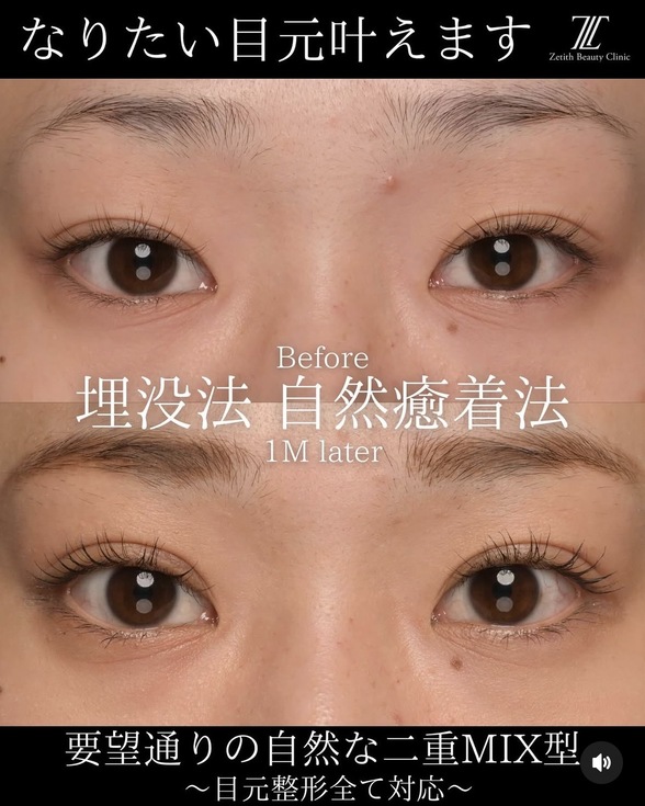 目元整形のビフォーアフターの写真