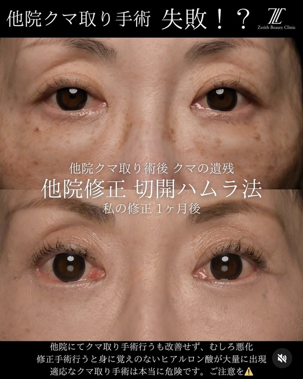 目元整形のビフォーアフターの写真