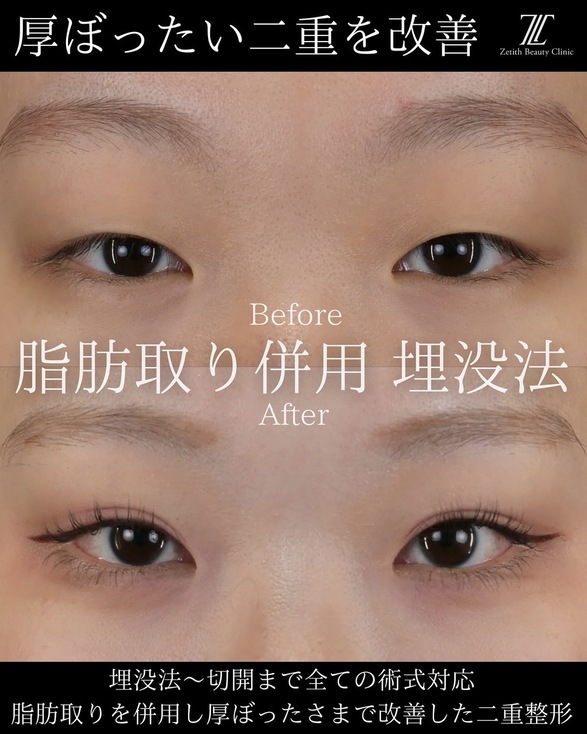 目元整形のビフォーアフターの写真