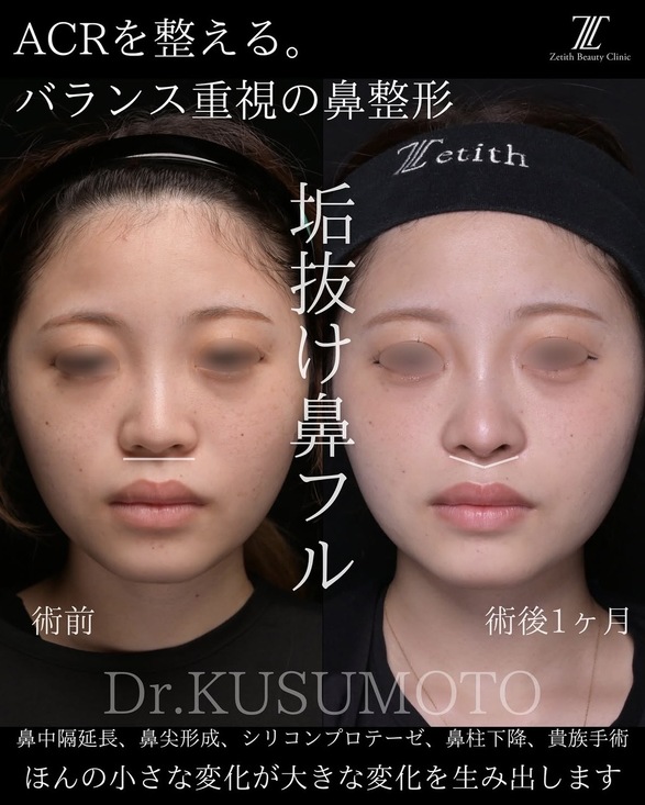 人中短縮 - ゼティスビューティークリニック｜鼻整形・鼻形成、美肌