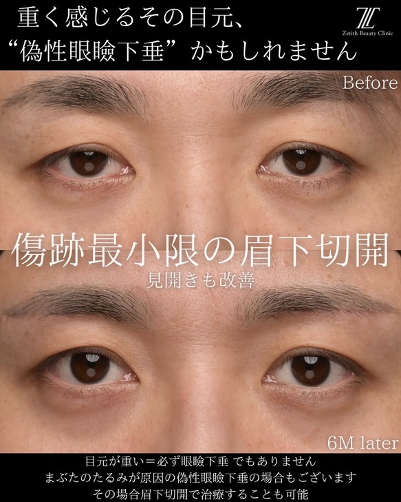 目元整形のビフォーアフターの写真