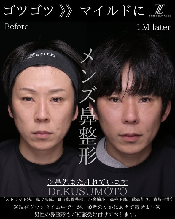 鼻整形のビフォーアフターの写真