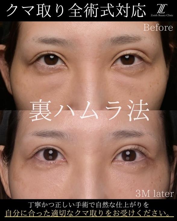 目元整形のビフォーアフターの写真
