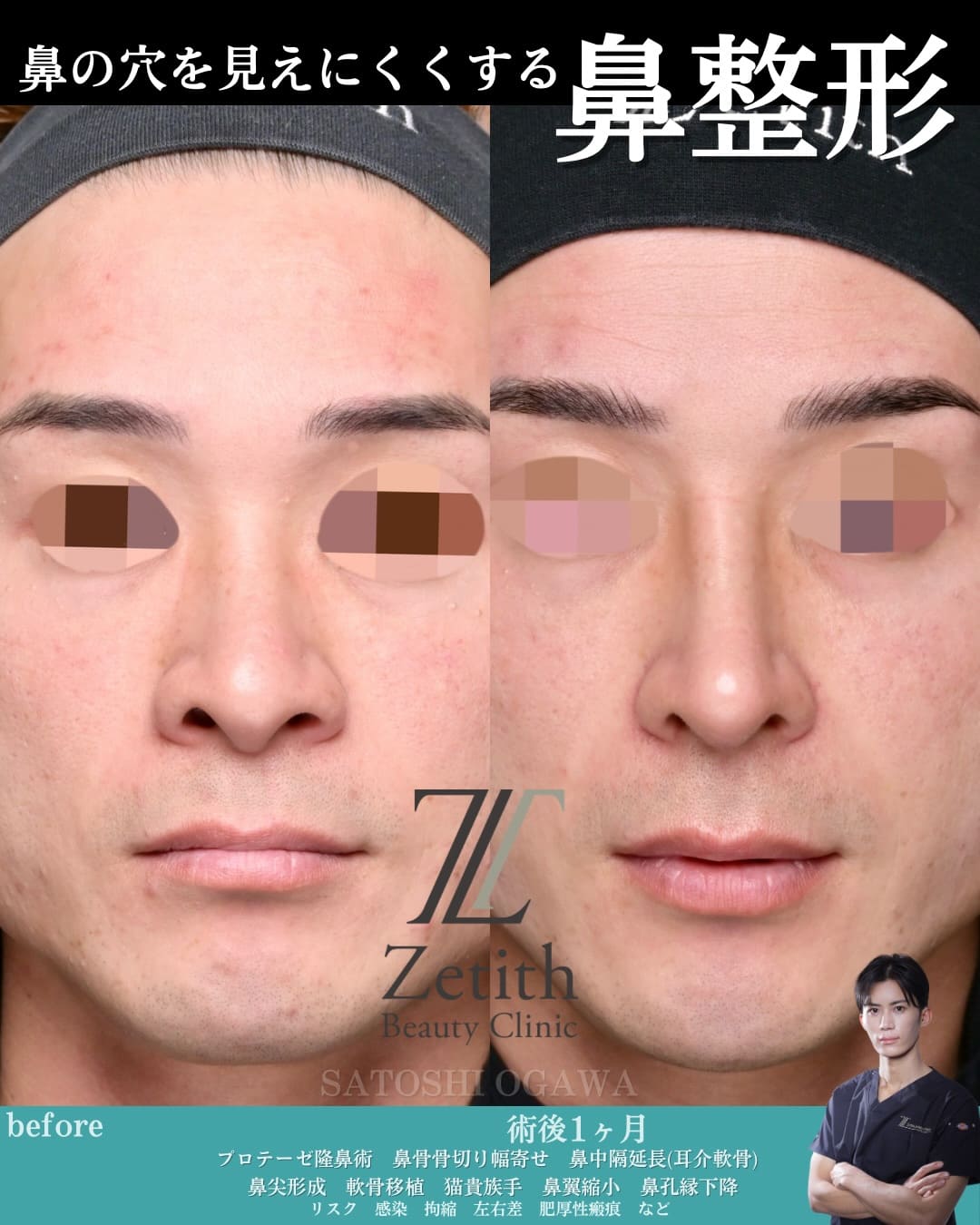 鼻整形のビフォーアフター写真(術前)