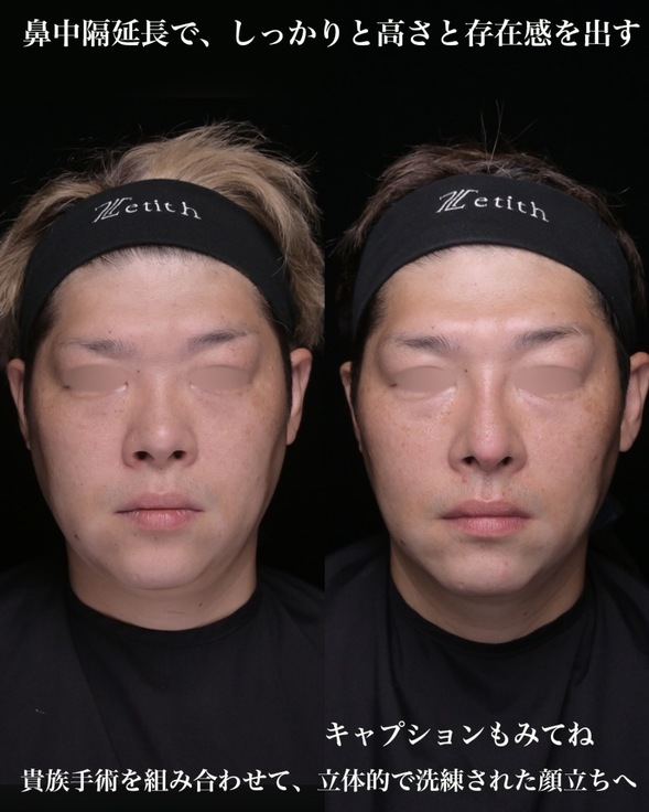 鼻整形のビフォーアフター写真