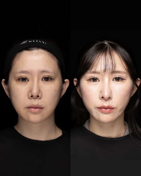 鼻整形のビフォーアフター写真