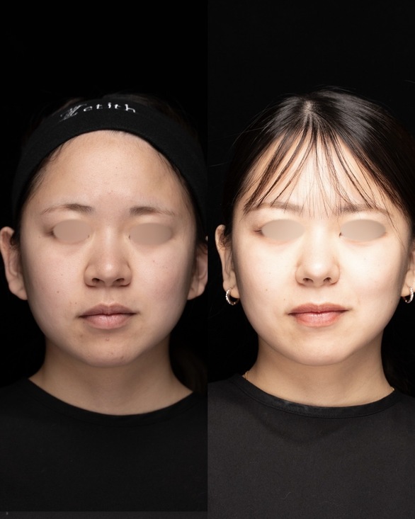 鼻整形のビフォーアフター写真