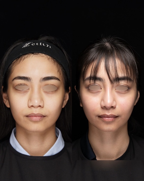 鼻整形のビフォーアフター写真