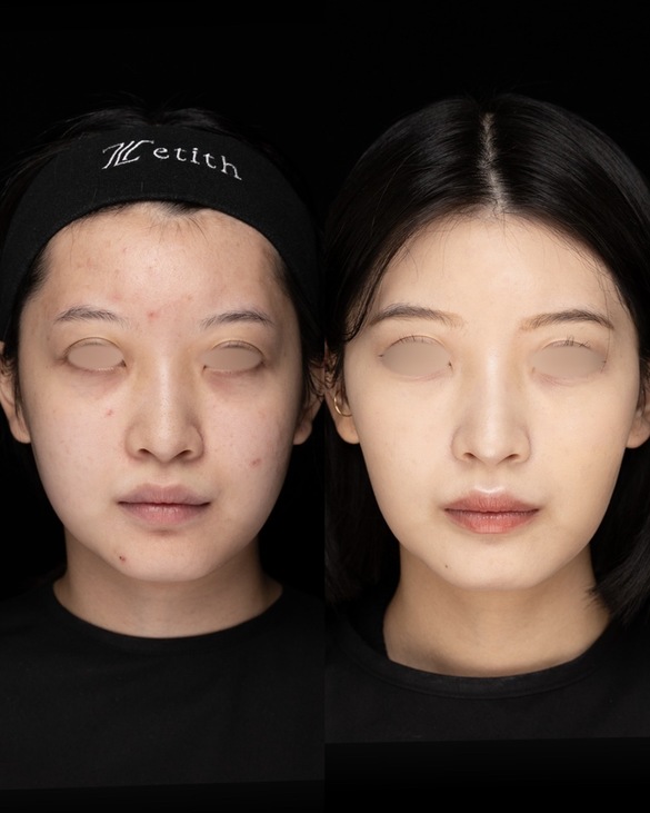 鼻整形のビフォーアフター写真