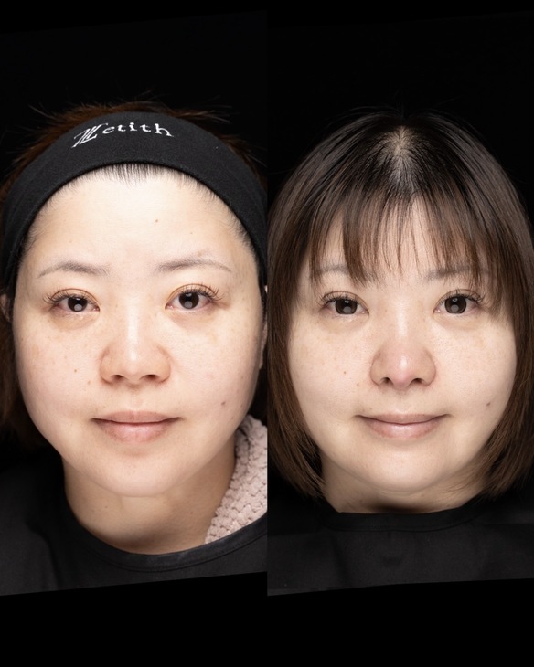 鼻整形のビフォーアフター写真