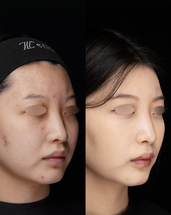鼻整形のビフォーアフター写真