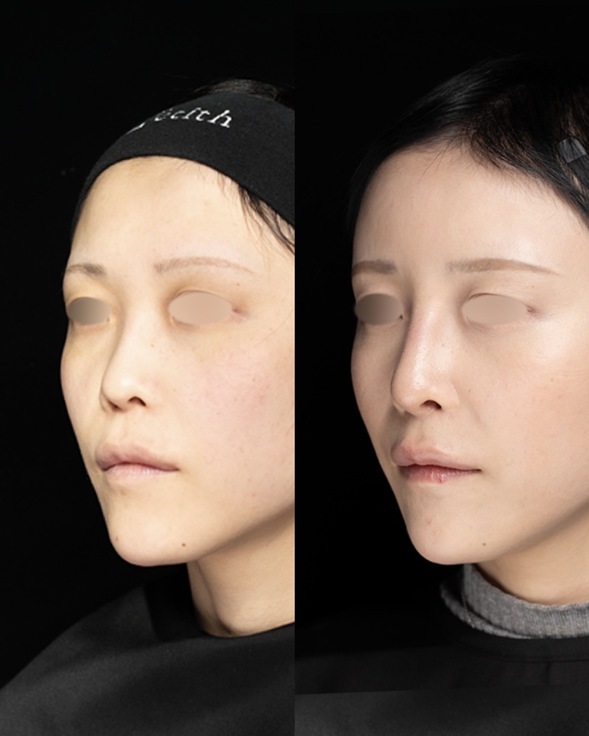 鼻整形のビフォーアフター写真