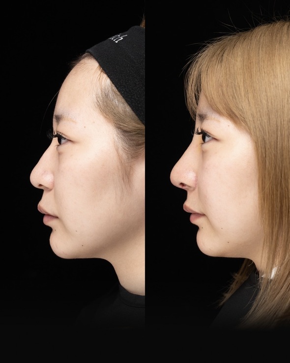 鼻整形のビフォーアフター写真