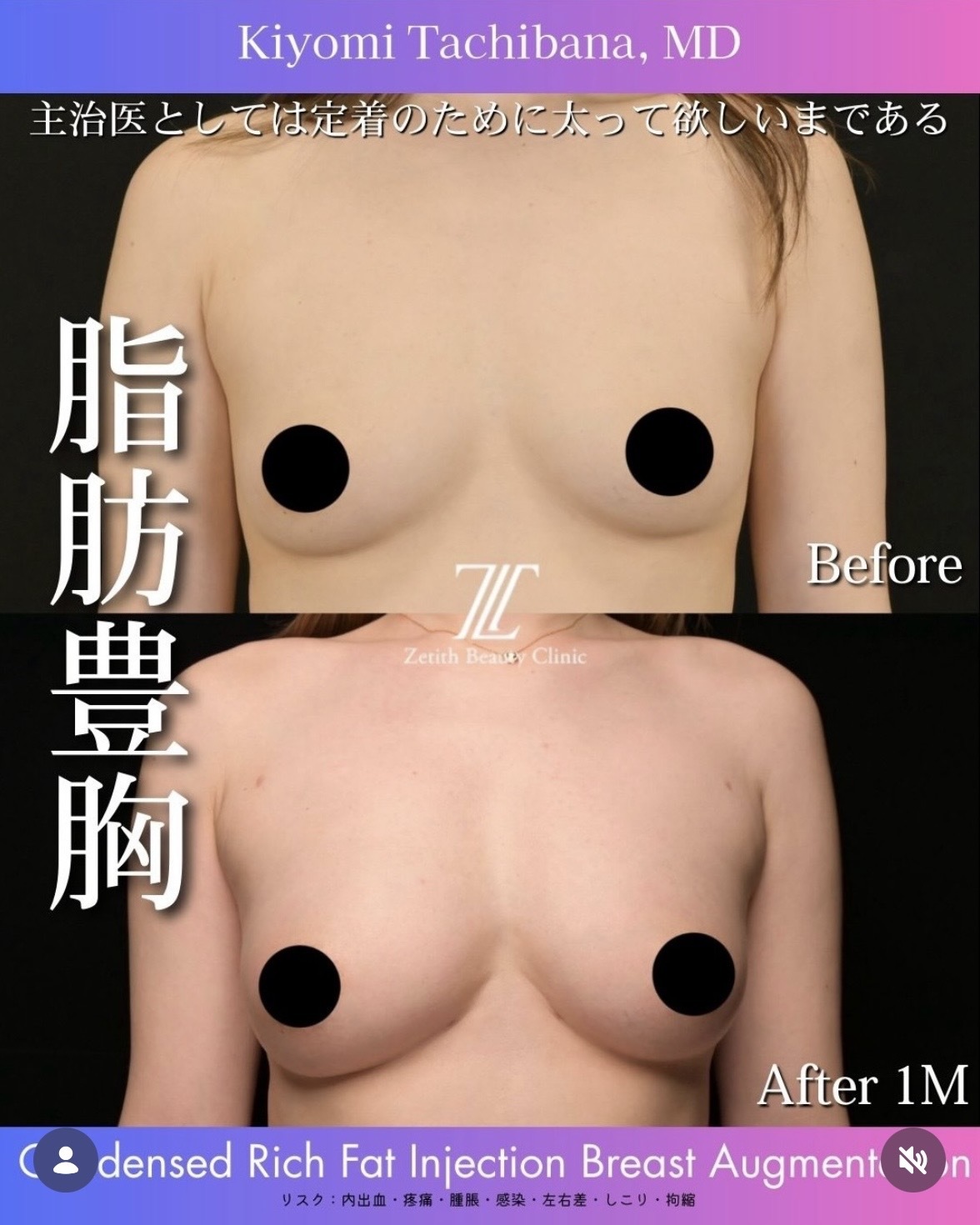 豊胸のビフォーアフター写真