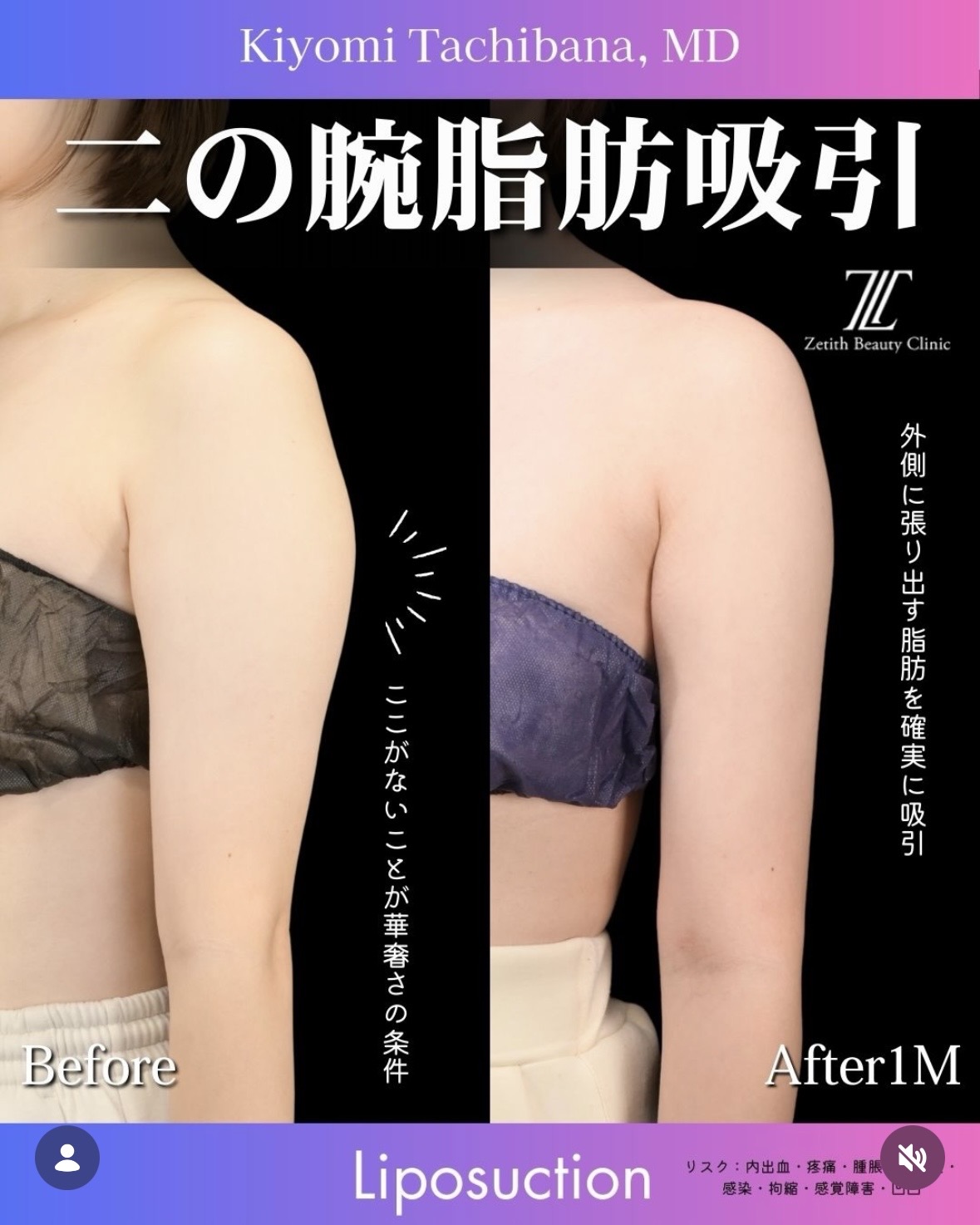 脂肪吸引のビフォーアフター写真