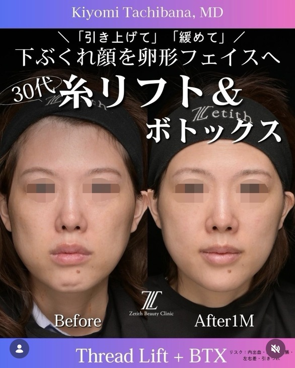 糸リフトのビフォーアフター写真