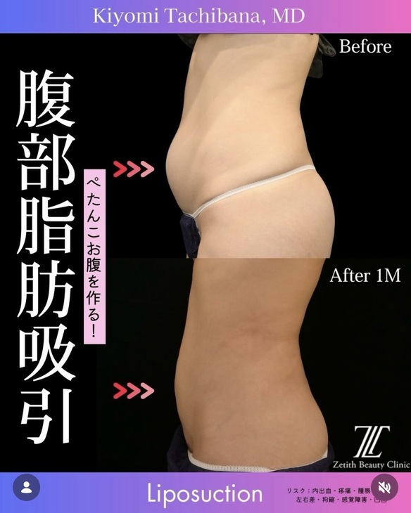 脂肪吸引のビフォーアフター写真