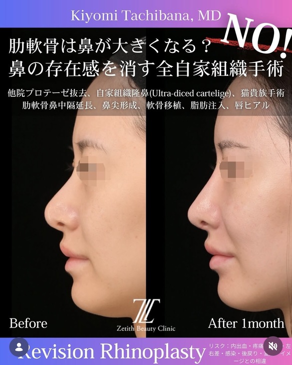 鼻整形のビフォーアフター写真