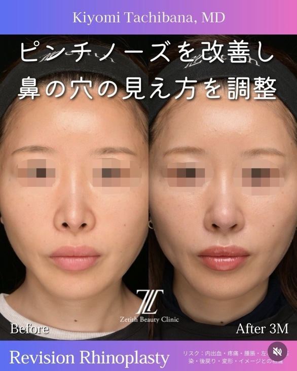 鼻整形のビフォーアフター写真