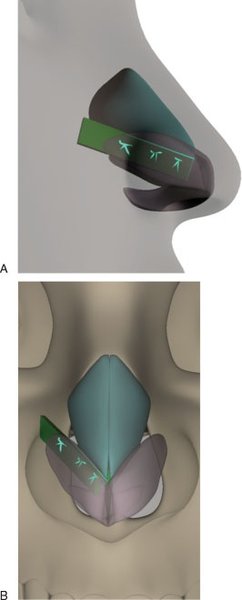 ラテラルクルラルストラットグラフトによる鼻翼軟骨補強の術式図