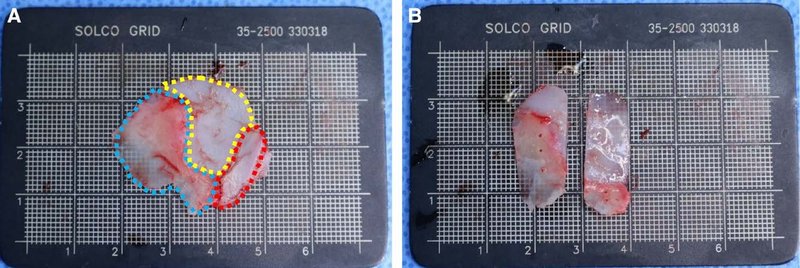 術中に採取された中隔軟骨・骨複合体(SCBC)の各部位