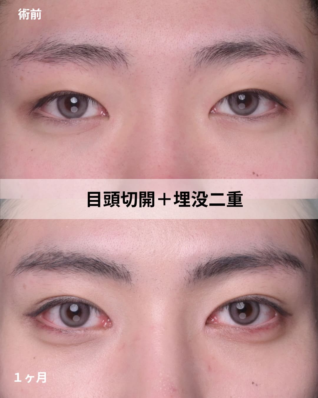 目元形成のビフォーアフター写真(術前)