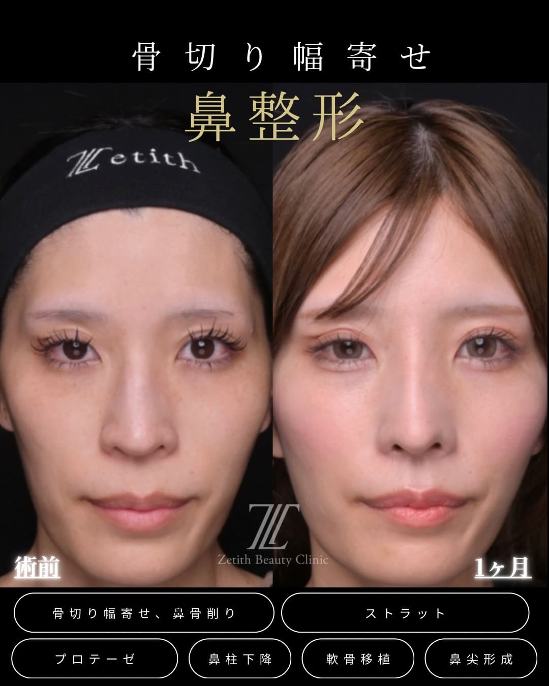 鼻整形のビフォーアフター写真(術前)