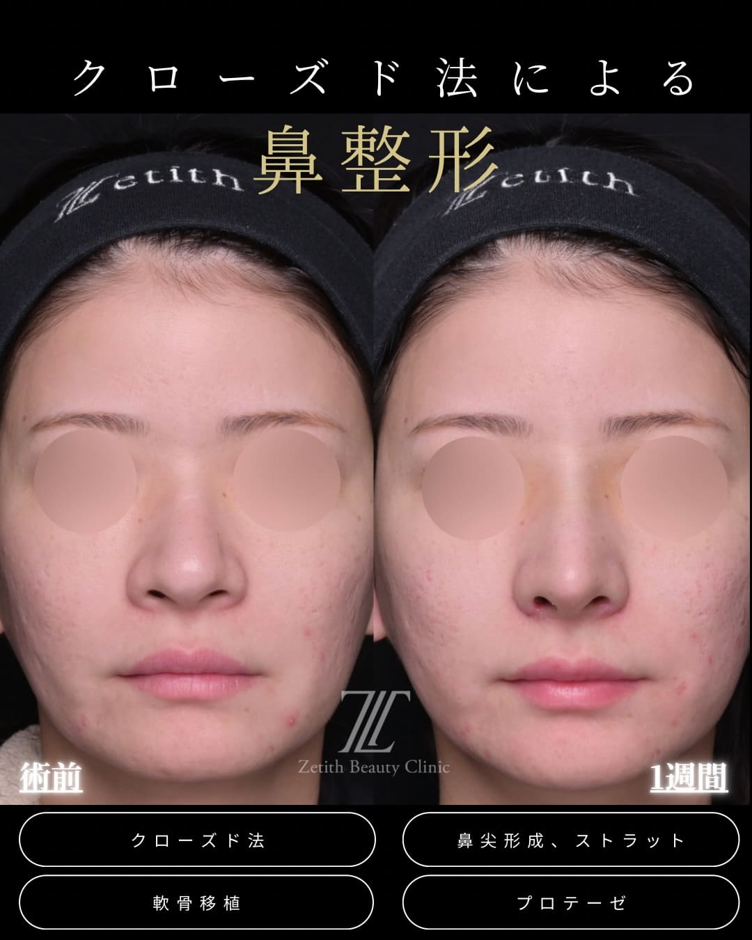 鼻整形のビフォーアフター写真(術前)