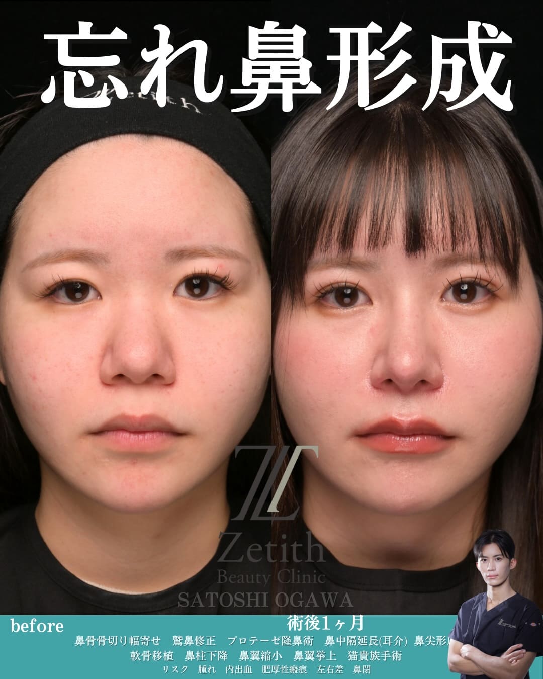 鼻整形のビフォーアフター写真(術前)