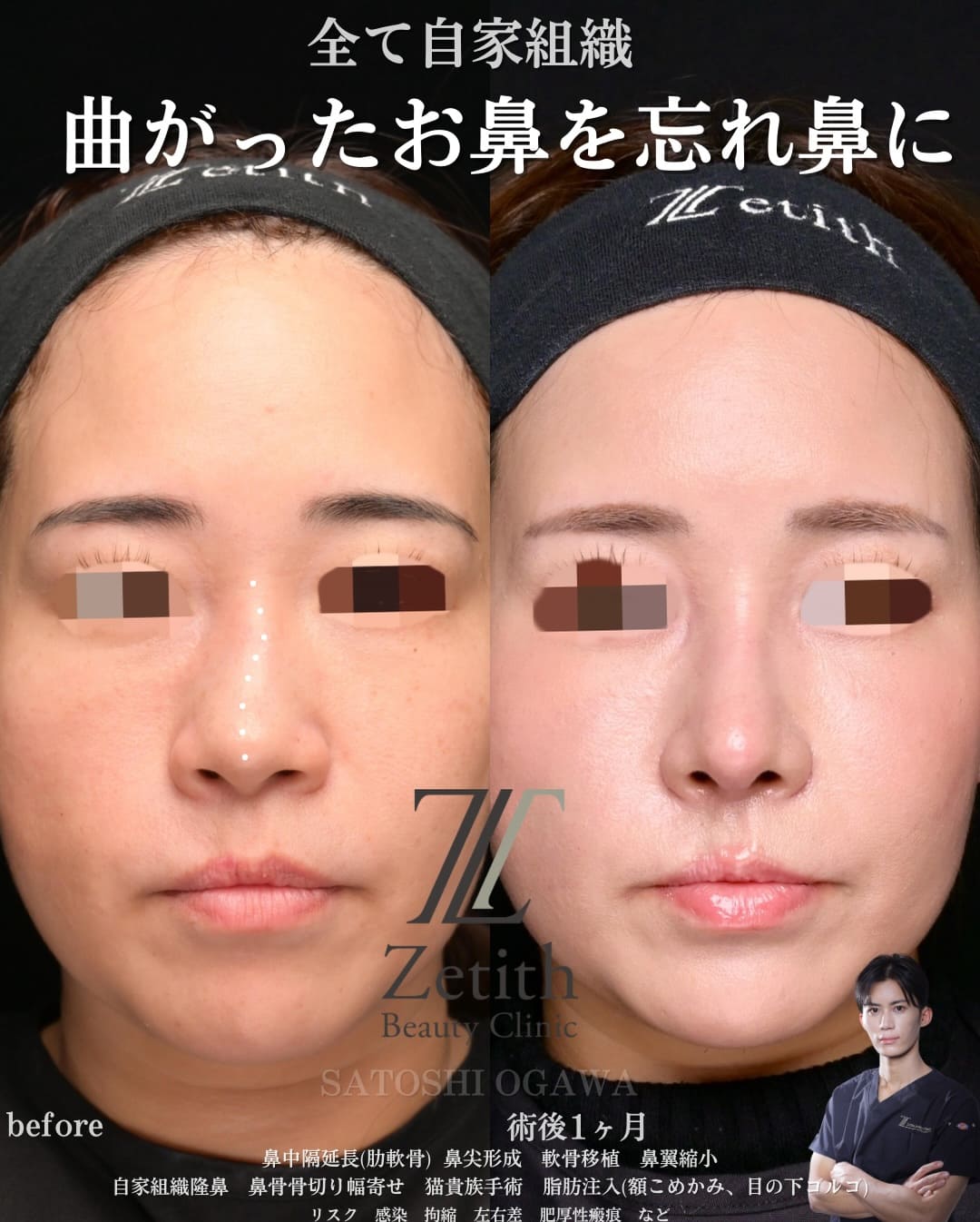 鼻整形のビフォーアフター写真(術前)
